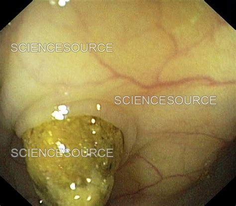 Diverticular Disease Of The Colon Stock Image Science Source Images