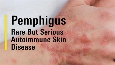 understanding pemphigus types   symptoms