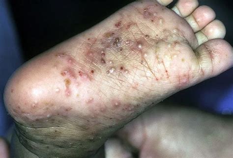 Mites On Humans Treatment