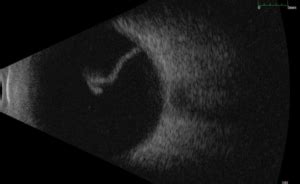 Ocular Ultrasonography Macula Retina Vitreous Center