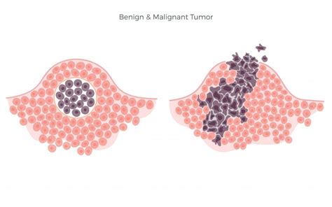 Benign And Malignant Tumors What Is The Difference