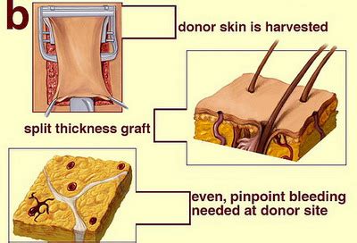 Skin Beauty - Skin Grafting Technique