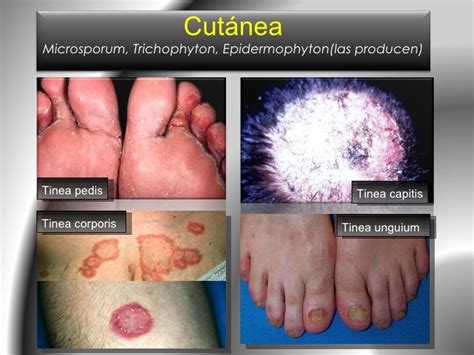 Micosis Superficiales Resumen Candidiasis Medicina Images