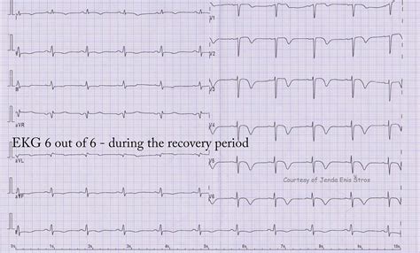 Teaching Series 1113: ECG 6 of 6 - Acute Anterior Wall M.I. | ECG Guru ...