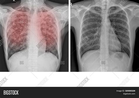 Chest X Ray Showing Image And Photo Free Trial Bigstock