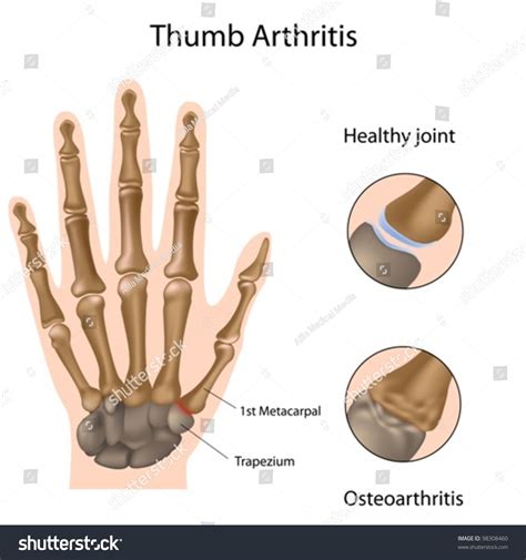 56 Carpometacarpal Joint Royalty-Free Photos and Stock Images ...