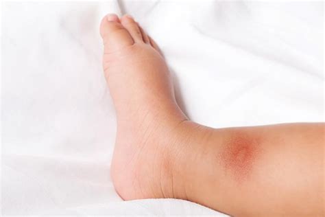 How To Treat Bedbug Bites On Babies