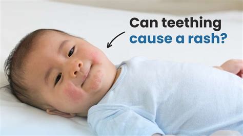 Can Teething Cause A Rash ? Discover the Facts