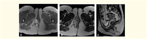 Mri Pelvis Axial T1 Weighted Image A Axial T2 Weighted Image B Download Scientific