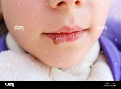 Candidiasis oral fotografías e imágenes de alta resolución Alamy