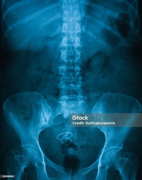 Xray Image Of Kub Supine View Stock Photo Download Image Now Istock