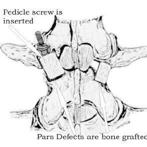 (PDF) Repair of pars interarticularis defect with a modified cable ...