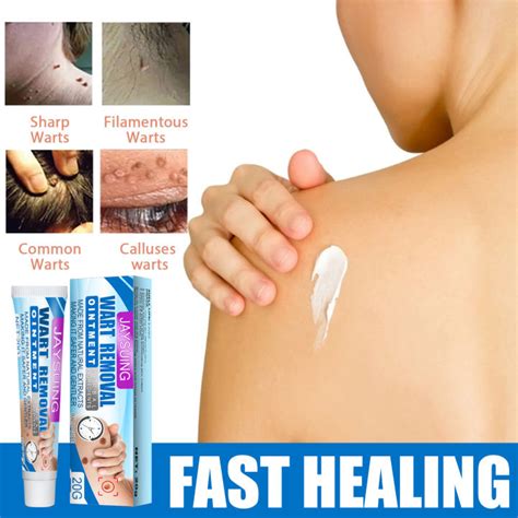 Wart Removal Ointment Warts Remover Original Wart Removing Cream To