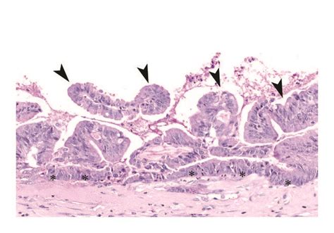 Microscopic Changes Replacement Of The Normal Appendiceal Mucosa With