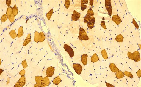 Light Microscopy Of Quadriceps Femoris Muscle Biopsy Showing Fiber Type