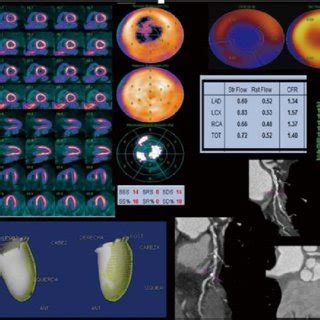 N Ammonia Pet Ct Normal Myocardial Perfusion Study Splash And