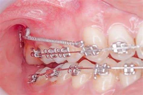 Microtornillos De Ortodoncia Estudi Dental Barcelona