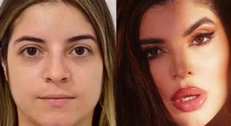 Gkay Antes E Depois Confira Os Procedimentos Que Ela Fez