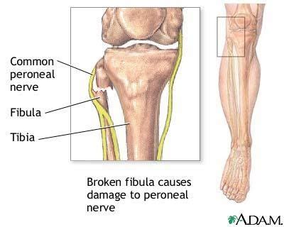 Common Peroneal Nerve Entrapment - Advance Foot Clinic