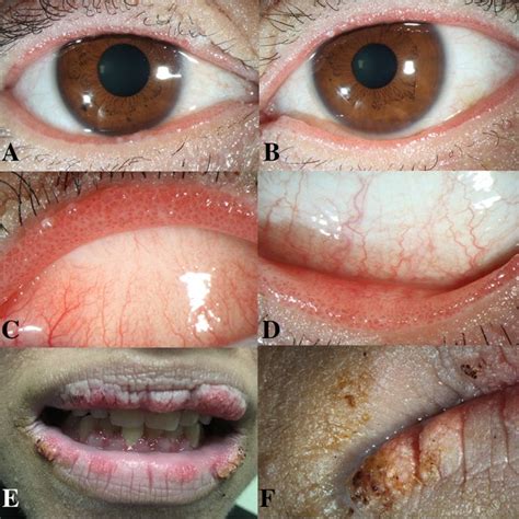 Patient Images A Anterior Segment Photograph Of The Right Eye And B