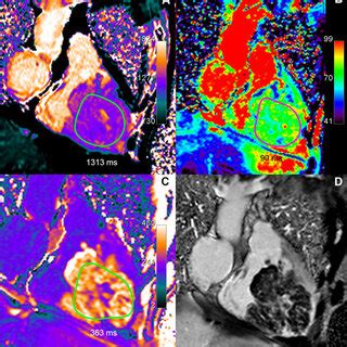 Renal cell carcinoma metastasis: Huge right ventricular metastasis of a ...