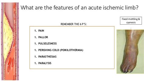 Critical Limb Ischemia Povd Dr Mnr