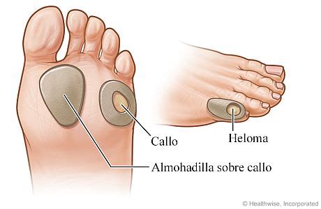 Almohadillas Protectoras Para Callos Y Helomas Cigna