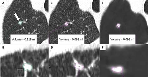 Vessel Suppressed Chest Computed Tomography For Semi Automated