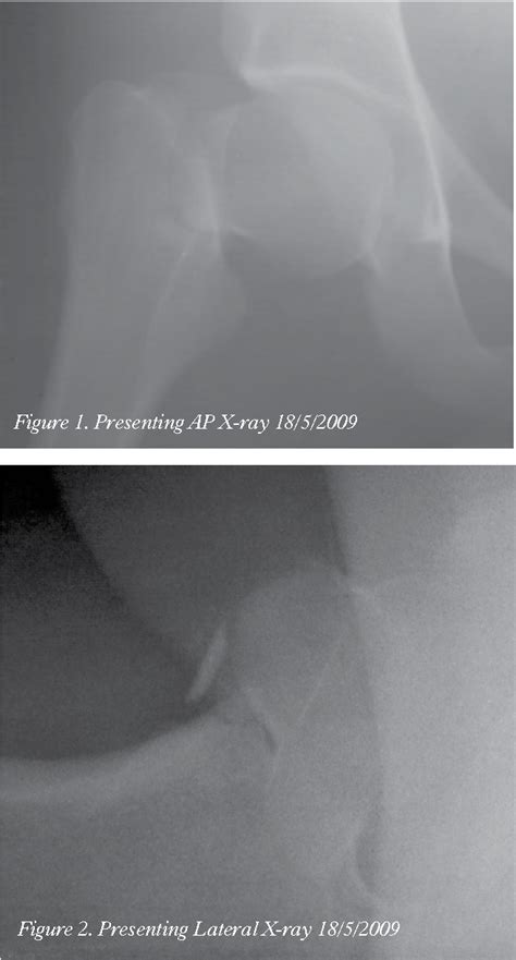 Figure 2 From Displaced Femoral Neck Stress Fractures In Royal Marine