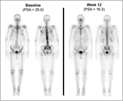 Bone Scan In Prostate Cancer