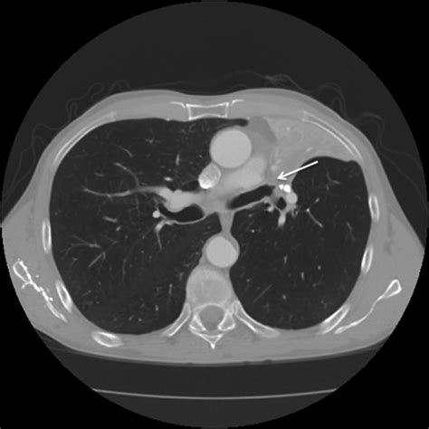 Luftsichel Sign And Juxtaphrenic Peak Sign Bmj Case Reports