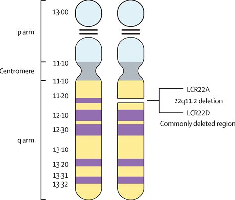 Neurobiological Perspective Of 22q112 Deletion Syndrome The Lancet