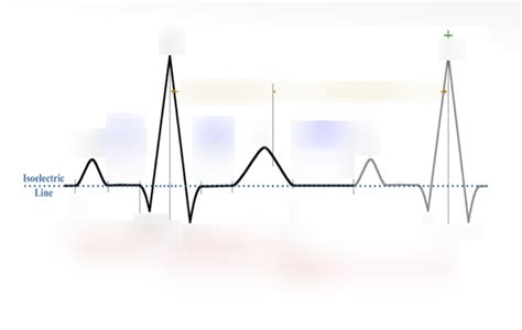 Ekq Quiz Id Ekg Diagram Diagram Quizlet