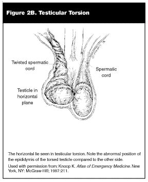 Testicular Torsion Diagram