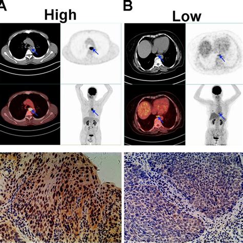 PET CT Imaging For ESCA Patient With Different SUVmax SUVmean TLG And