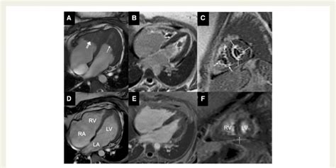 Cardiac Magnetic Resonance Imaging Cmr A Cine Image Using Ssfp