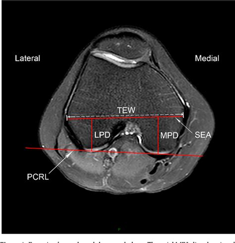 Figure From Tibial Tubercle To Trochlear Groove Distance Measured By