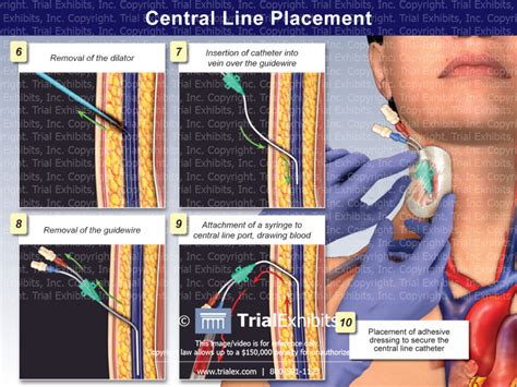 Ultrasound Guided Central Line Placement Made Easy Off