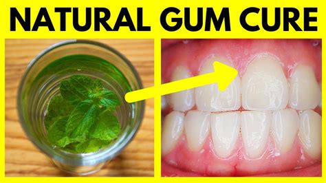 Best Mouthwash For Gum Disease Cure Periodontal Disease And Gingivitis Natural Home Remedy