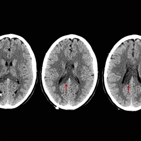 Diffuse Axonal Injury Mri - Diffuse Axonal Injury (DAI) - MRI Online ...