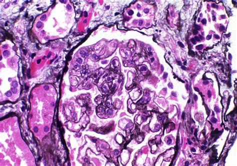 AJKD Atlas Of Renal Pathology Thrombotic Microangiopathy American