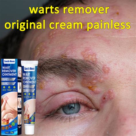 Warts Remover Cream Warts Magic Remover Wart Ointment Warts Remover Skin Growth Warts Remover ...