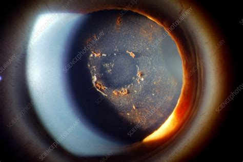 Anterior Uveitis Slit Lamp