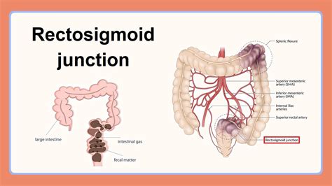 Rectosigmoid Junction Youtube