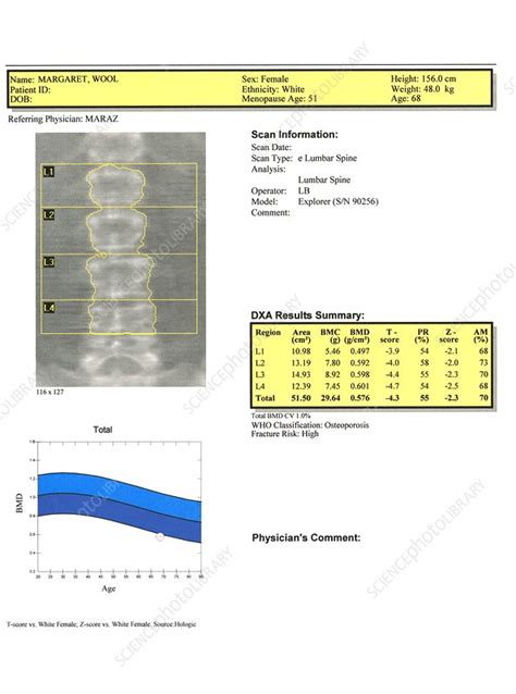 Bone density scan - Stock Image - C021/0452 - Science Photo Library