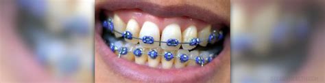 Types of orthodontic braces | General center | SteadyHealth.com