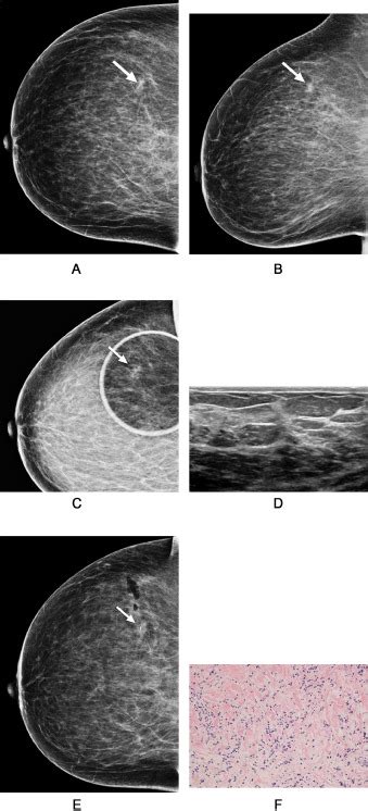 Stereotactic Vacuum Assisted Needle Biopsy Outcomes Of Non Calcified Mammographic Lesions