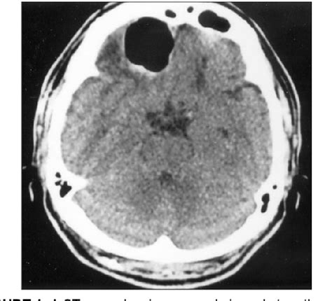 Figure From Delayed Tension Pneumocephalus Due To Rupture Of The