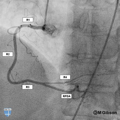 Coronary Angiography Right Coronary Artery Wikidoc