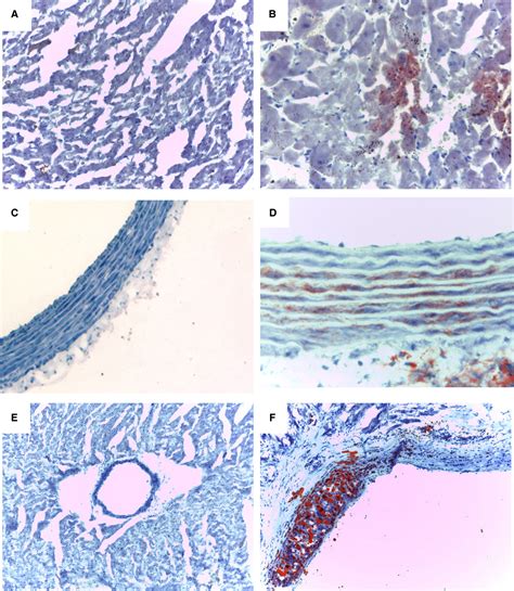 Vascular Proteaseactivated Receptor 4 Upregulation Increased Platelet